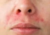 Dermatita seboreică: simptome și cauze